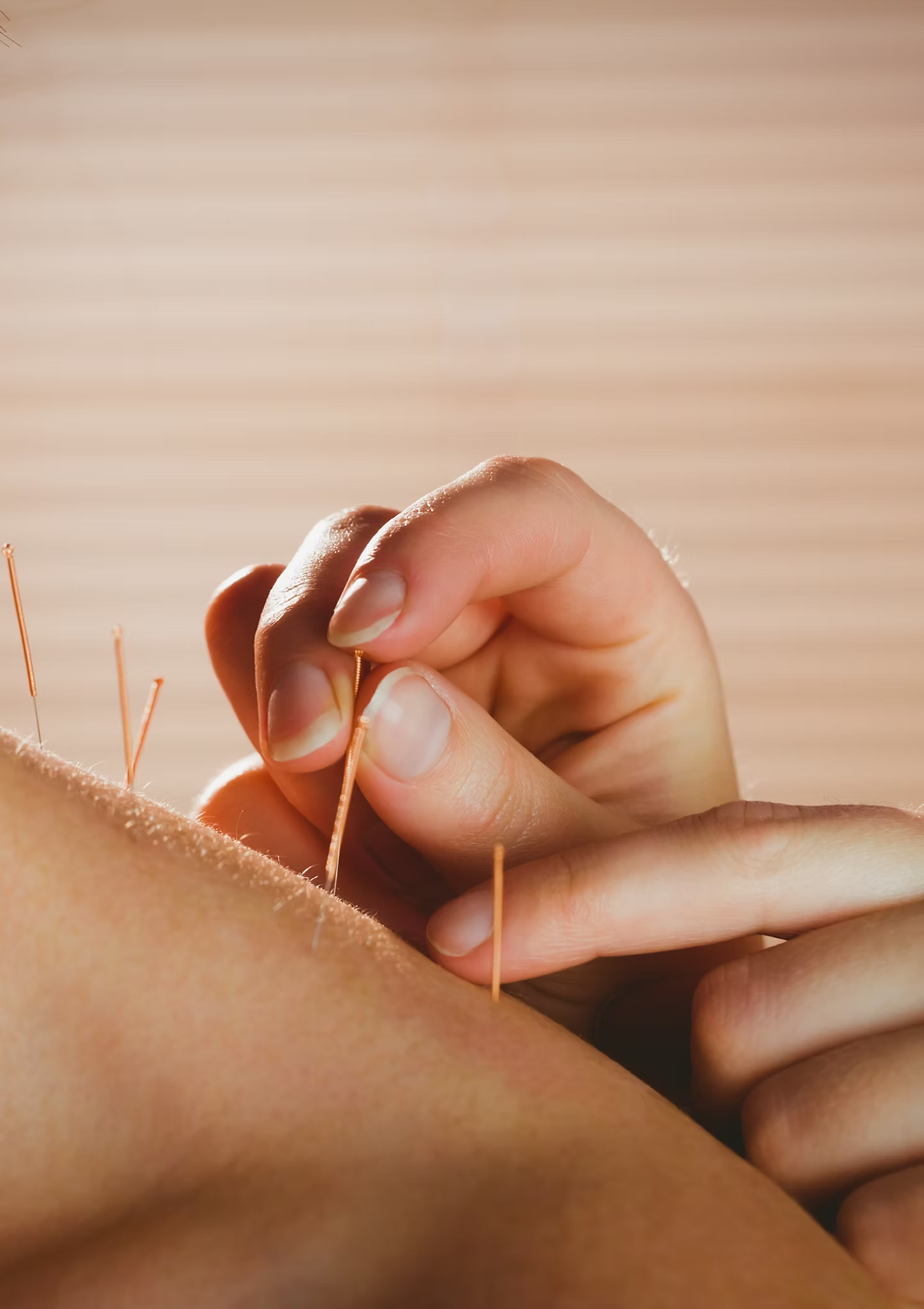 Hands placing acupuncture needles